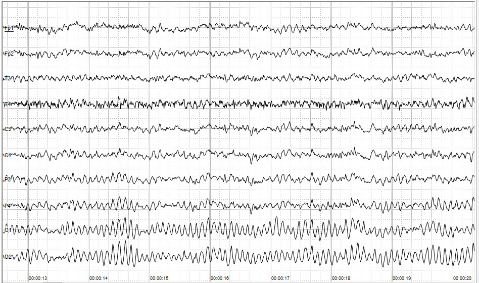 Resting state image. Each wave corresponding to an electrode placed on the scalp. By Andrii Cherninskyi.